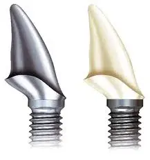 ABUTMENT.webp